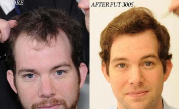 Hair restoration procedure before and after results