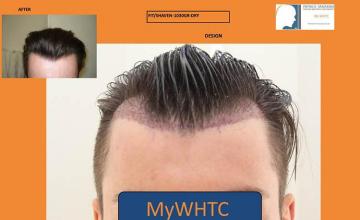 Before and after hair transplant procedure images