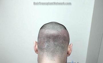 Hair restoration procedure before and after pictures