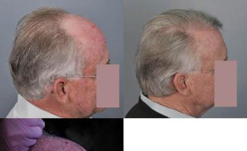 Hair transplantation surgery before and after images