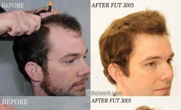 Hair transplantation surgery before and after images