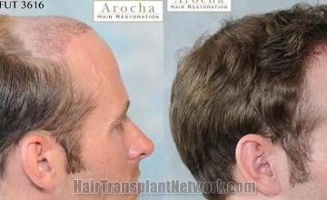 Hair transplantation surgery before and after images