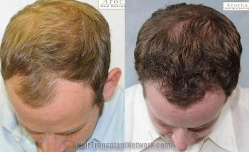 Hair transplantation surgery before and after photos