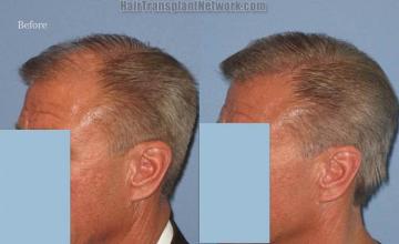 Hair transplantation surgery before and after pictures