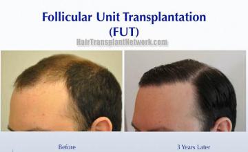 Surgical hair transplantation result photographs