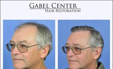 Hair transplant surgery before and after pictures