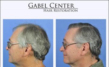 Hair transplantation surgery before and after photos