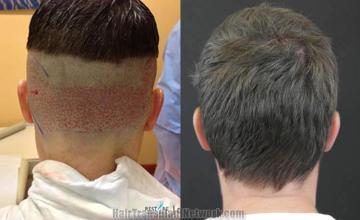 Hair transplantation surgery before and after pictures