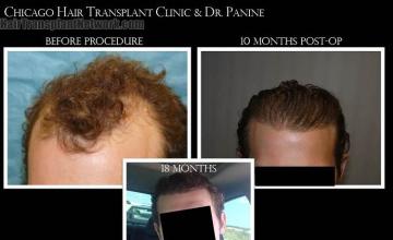 Hair restoration procedure before and after pictures