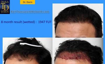 Hair transplantation surgery before and after pictures