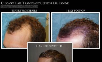 Hair transplantation surgery before and after images