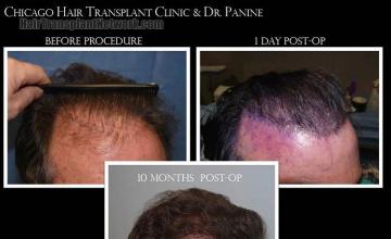 Hair transplantation surgery before and after images