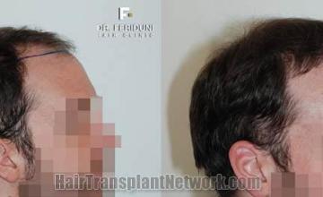 Hair transplantation surgery before and after images