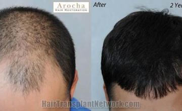 Hair restoration procedure before and after pictures