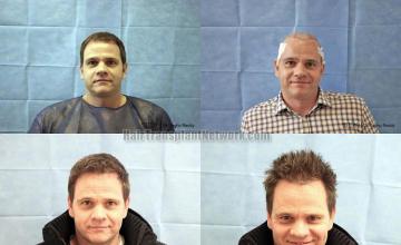 Hair transplantation surgery before and after pictures