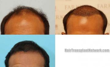 Hair restoration procedure before and after results