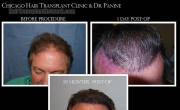 Hair restoration procedure before and after results