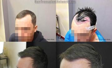 Hair transplantation surgery before and after images