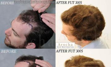 Hair transplantation surgery before and after pictures