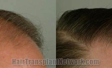 Hair transplantation surgery before and after images