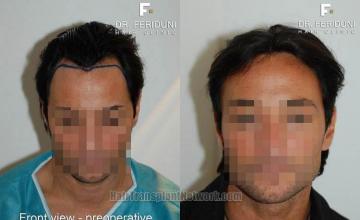 Hair restoration procedure before and after results