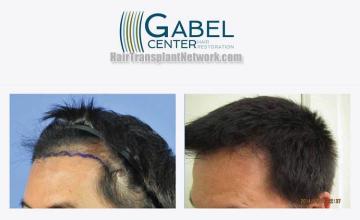 Hair transplantation surgery before and after photos