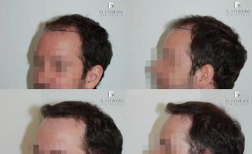 Hair transplantation surgery before and after pictures