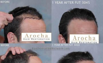 Hair transplantation surgery before and after images