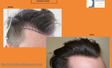 Hair restoration procedure before and after pictures