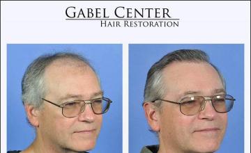 Hair restoration surgery before and after images