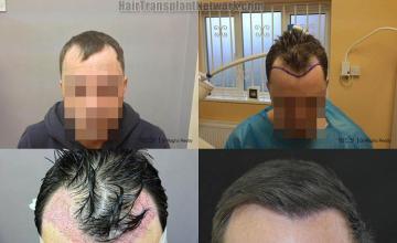 Hair transplantation surgery before and after photos