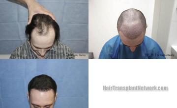 Hair restoration procedure before and after results