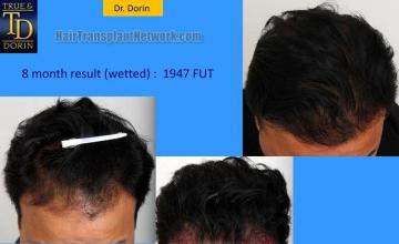 Hair transplantation surgery before and after photos