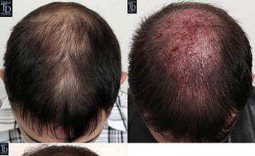 Hair transplantation surgery before and after pictures