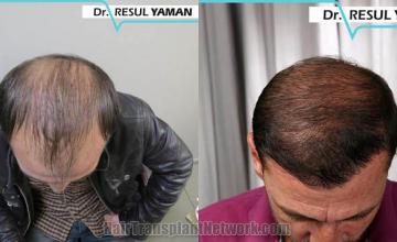 Before and after hair transplant procedure images