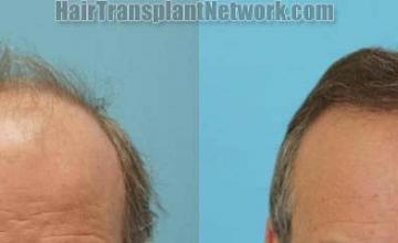 Hair transplantation surgery before and after images