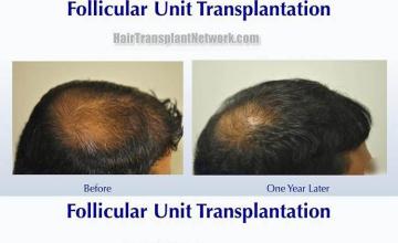 Hair restoration procedure before and after results