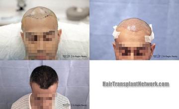 Hair restoration procedure before and after results