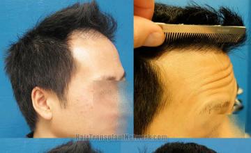 Hair transplantation surgery before and after images