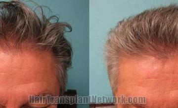 Hair transplantation surgery before and after images