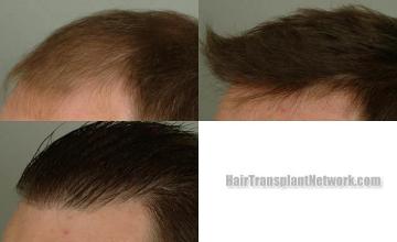 Hair transplantation surgery before and after images