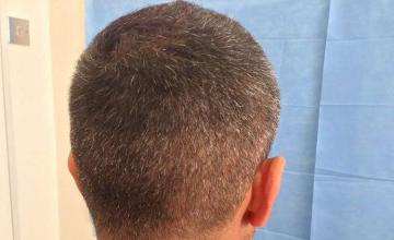 Hair transplantation surgery before and after pictures