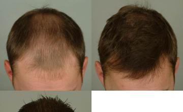 Hair transplantation surgery before and after photos