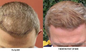 Hair restoration procedure before and after pictures