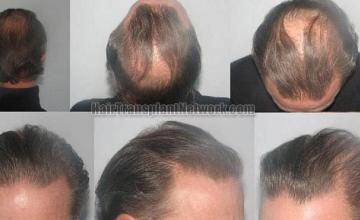 Hair restoration procedure before and after results