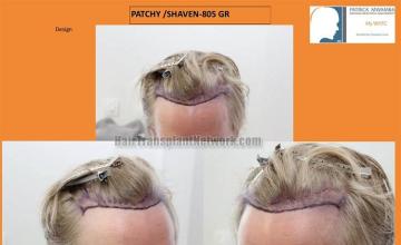 Hair transplant surgery before and after photos