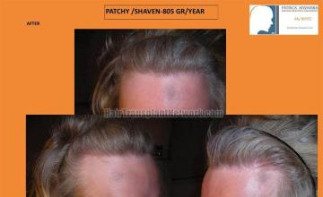 Hair transplant surgery before and after photos