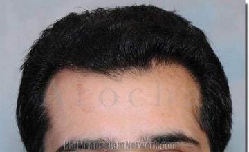 Hair restoration procedure results