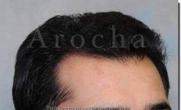 Hair restoration procedure results