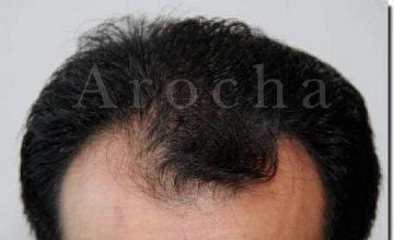 Hair restoration procedure results